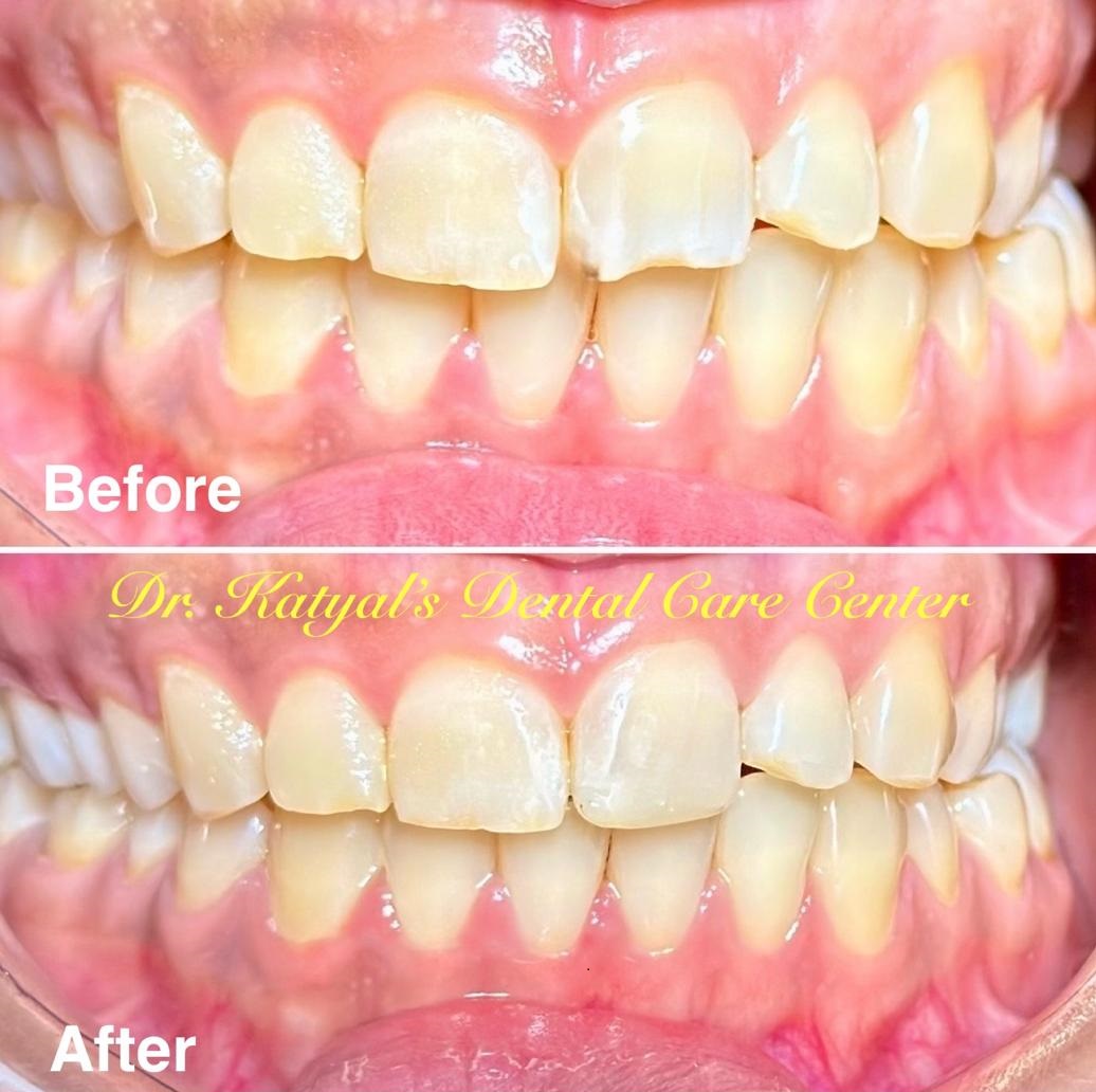 Anterior Cosmetic Fillings-2