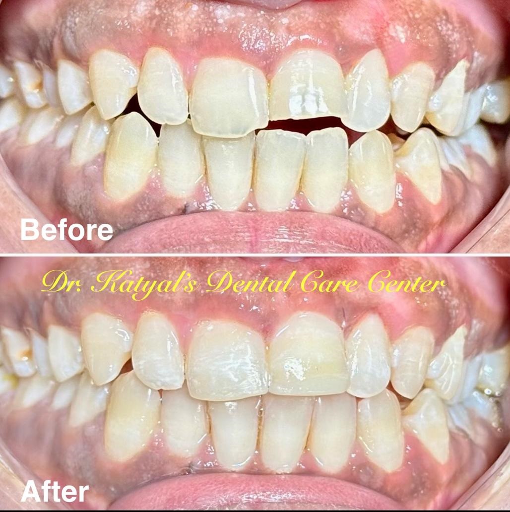 Cosmetic Fillings